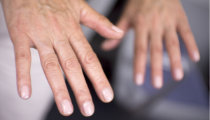 O lúpus é contagioso? Conheça esta doença autoimune
