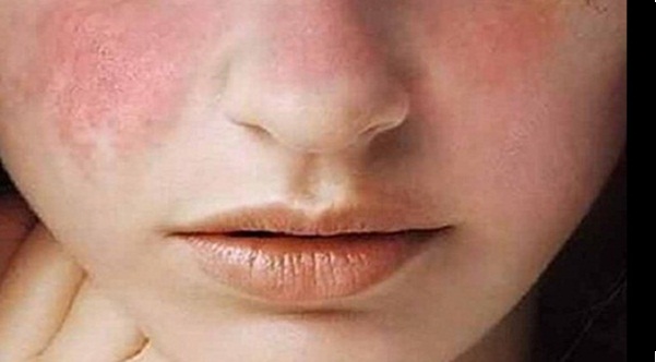 O lúpus é contagioso? Conheça esta doença autoimune