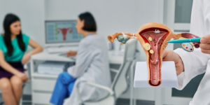 Miomas Uterinos: Sintomas, Causas e Diagnósticos