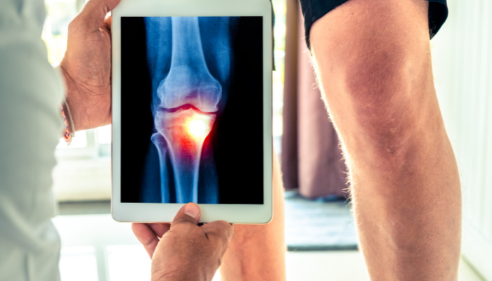 Artrite, artrose e osteoporose: entenda as diferenças para cuidar melhor de você