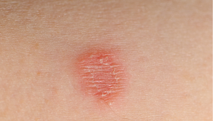 Impinge (Tinea): prevenção e sinais de alerta