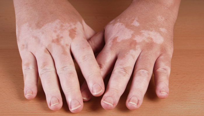 Causas do Vitiligo: Por que as Manchas Brancas Aparecem?