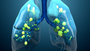 Pneumonia: identificando os sinais de alerta