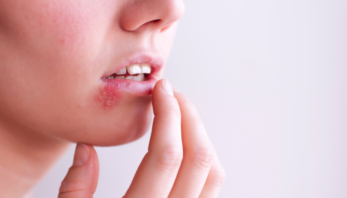 Herpes labial: dicas práticas para recuperação rápida